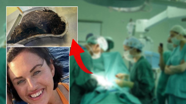 Doktorları bile şaşkına çeviren olay: Aylarca karın ağrısı çeken 14 yaşındaki Erin’in midesinden inanılmaz bir kitle çıktı